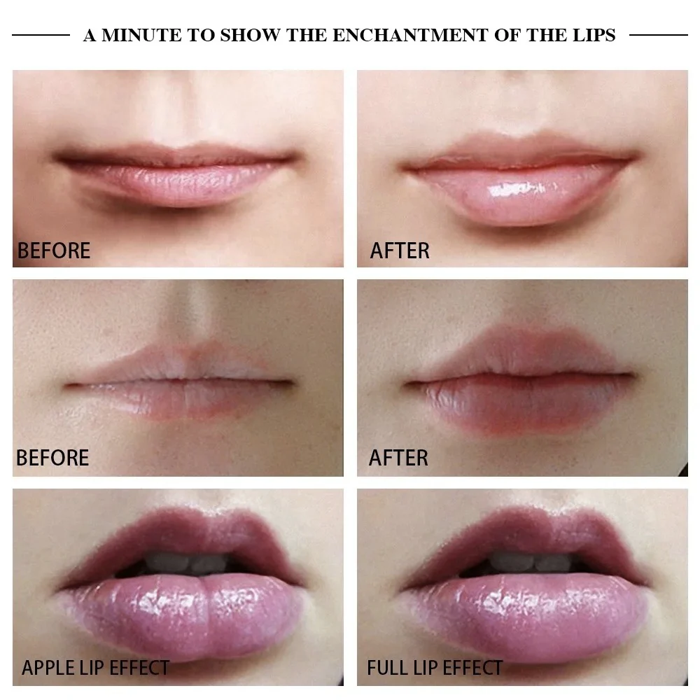 Lip Augmentation Device